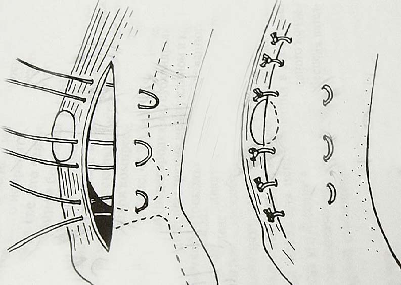 Дупликатура капсулы коленного сустава