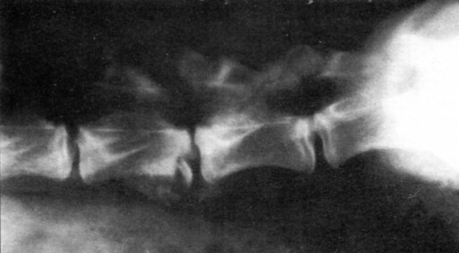 множественного перелома и переломом в L5 в сочетании с повреждением межпозвоночного диска